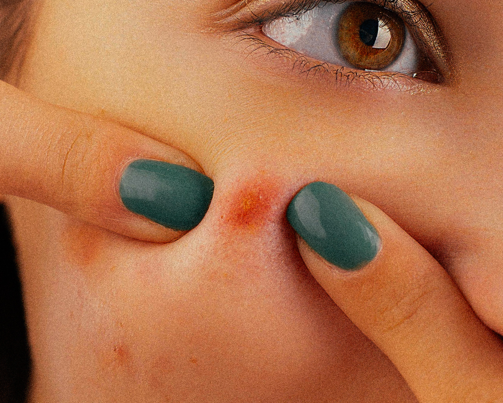 Antimicrobial & Antiacne Properties