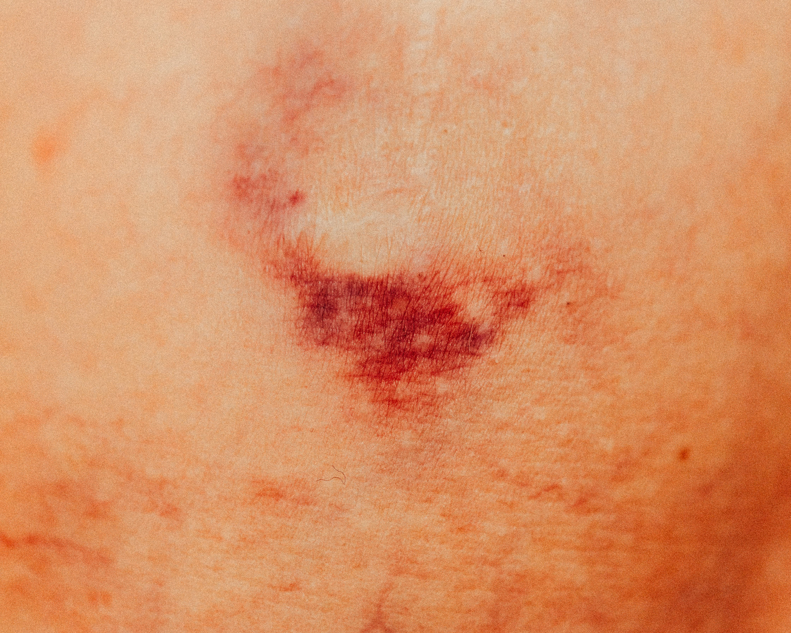 Wound Healing & Anti-inflammatory